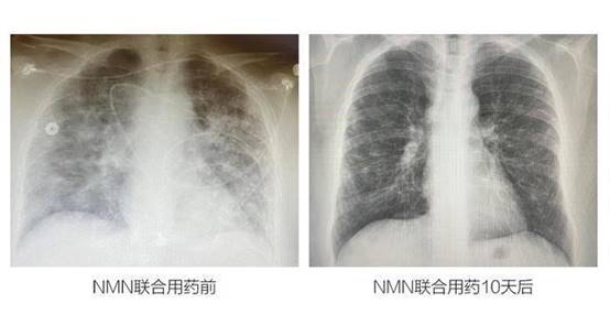 重磅！成功治愈新冠重癥，免疫水平提升85%！MISSPEP帶你了解神奇的“NMN”