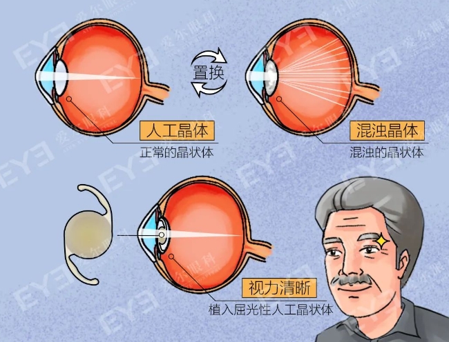 用技術硬實力保障手術質量，愛爾眼科助白內障患者解決頑固眼疾