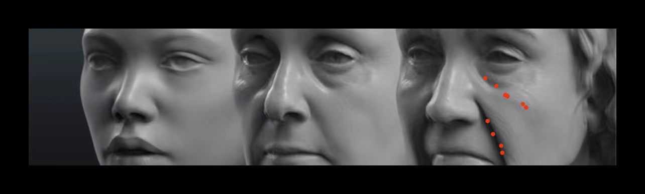 薛志強：中面部是高端玻尿酸求美者需求之首，也是饅化重災區