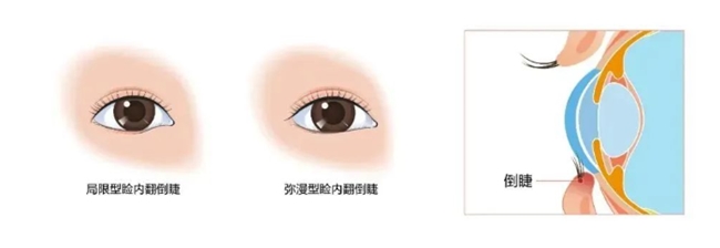 愛爾眼科：“倒睫”不容忽視！嚴重可影響視力